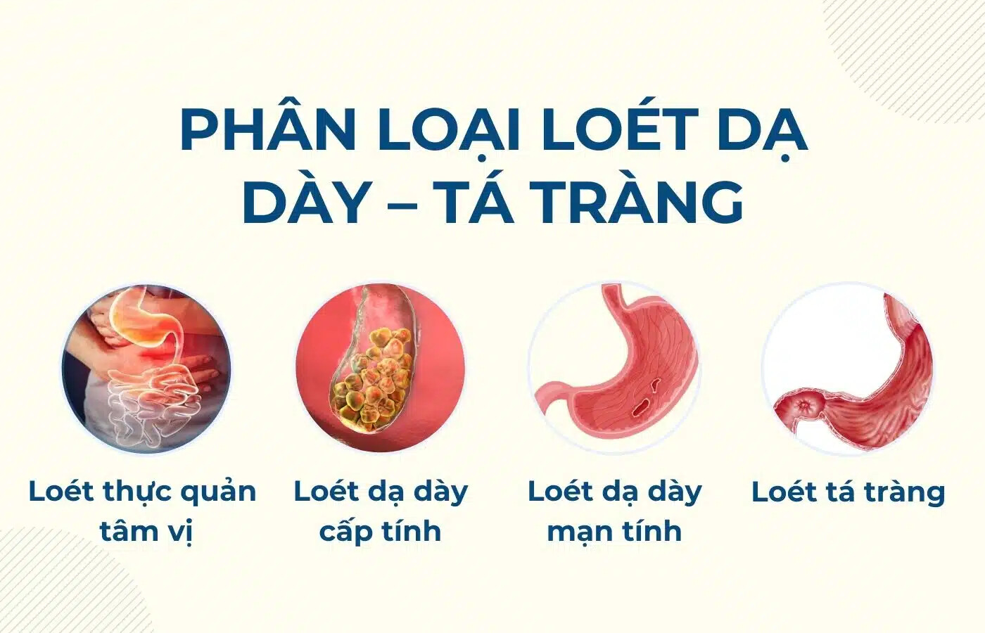 Chứng đầy bụng khó tiêu có thể là triệu chứng của bệnh lý viêm loét dạ dày – tá tràng